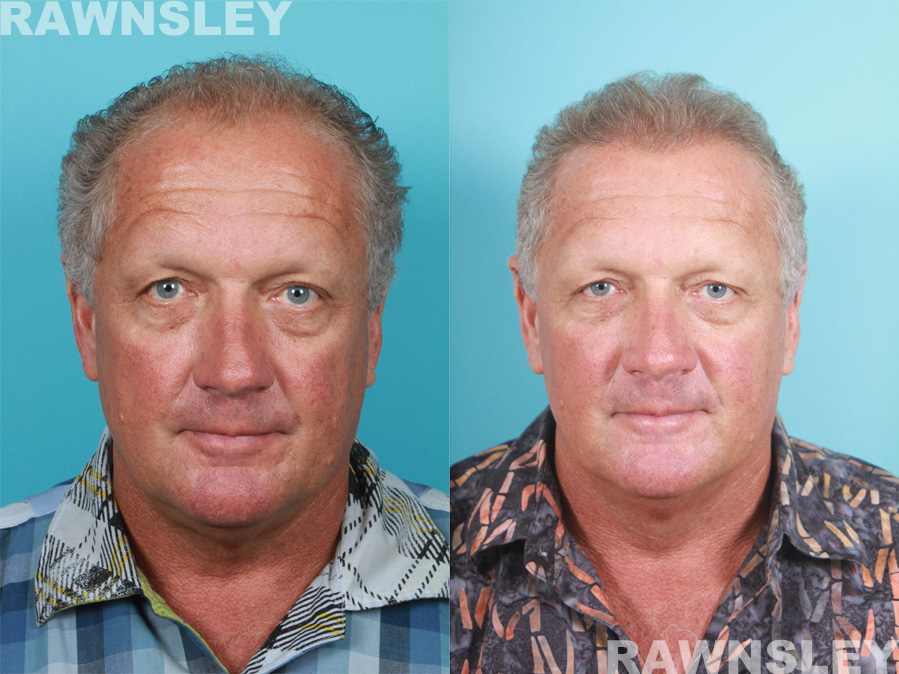 Hair Restoration Before and After Treatment Photos | Case 5 | Rawnsley Hair Restoration in Los Angeles, CA