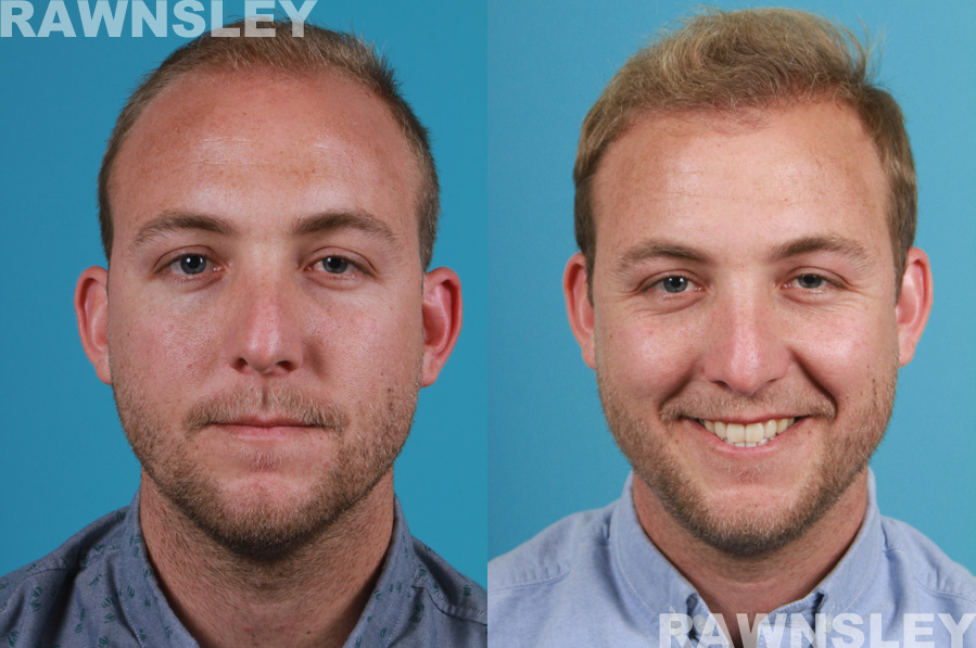 Hair Restoration Before and After Treatment | Case 17 | Rawnsley Hair Restoration in Los Angeles, CA
