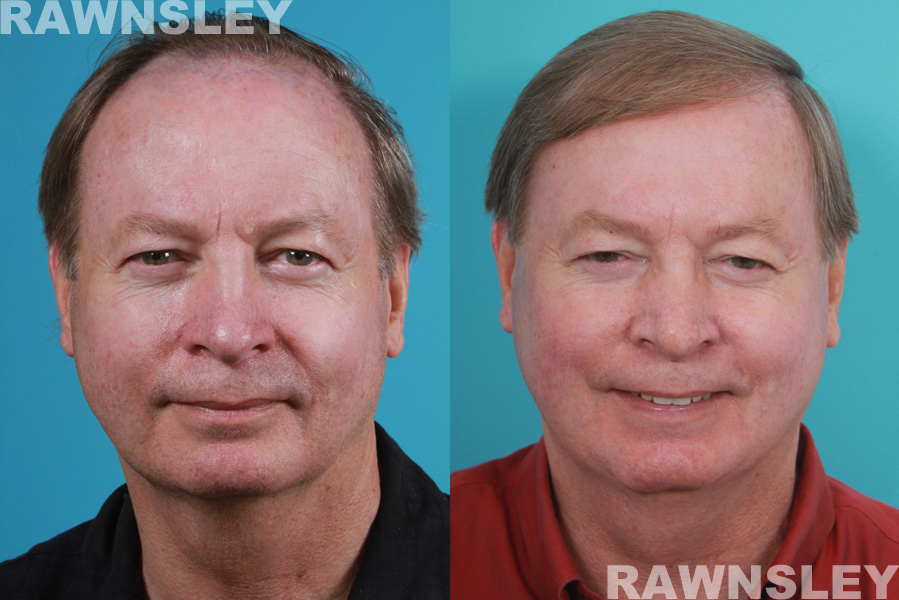 Hair Restoration Before and After Photos | Case 19 | Rawnsley Hair Restoration in Los Angeles, CA