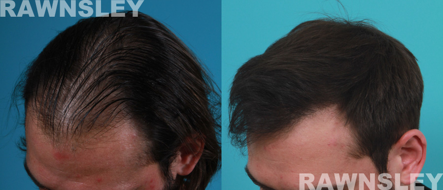 Hair Transplant Before and After | Case 21 | Rawnsley Hair Restoration in Los Angeles, CA