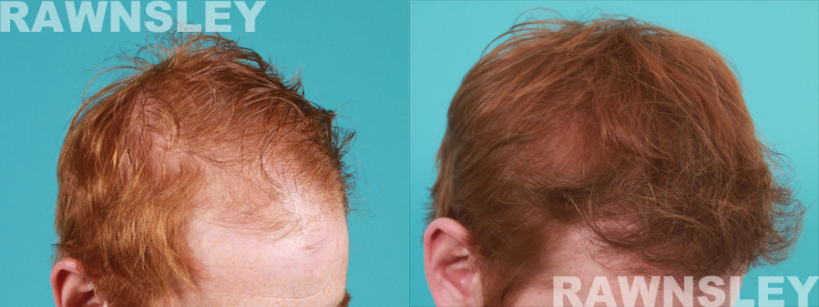 Hair Transplant Before & After | Case 22 | Rawnsley Hair Restoration in Los Angeles, CA