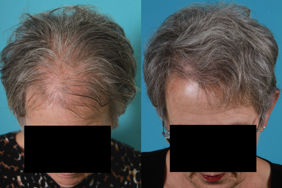 Hair Restoration Before & After Woman | Case 15 | Rawnsley Hair Restoration in Los Angeles, CA