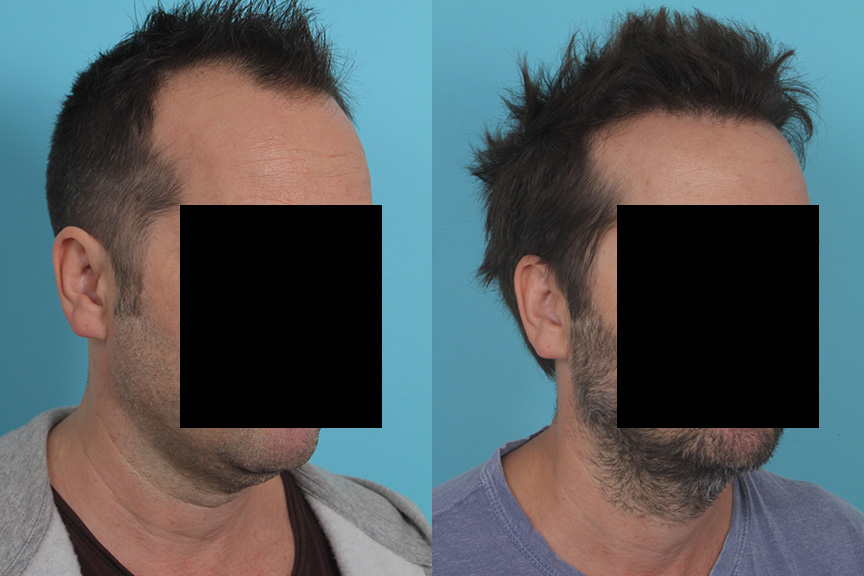 Hair Transplant Before & After Treatment | Case 26 | Rawnsley Hair Restoration in Los Angeles, CA