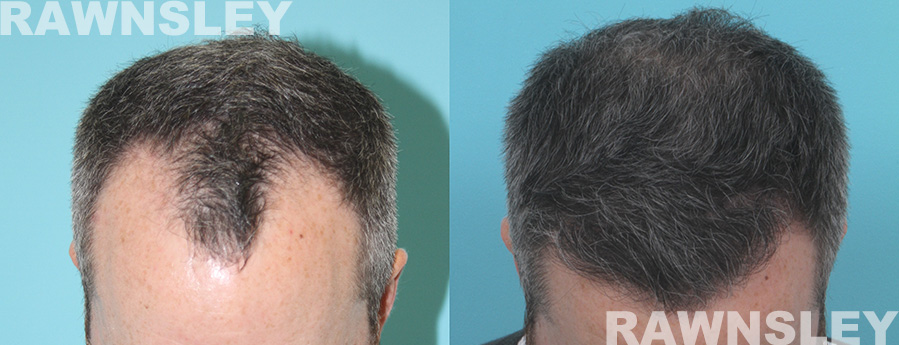 Hair Transplant Before & After Images | Case 27 | Rawnsley Hair Restoration in Los Angeles, CA