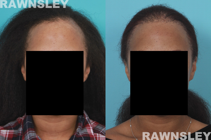 Hair Restoration Before & After Treatment | Case 28 | Rawnsley Hair Restoration in Los Angeles, CA