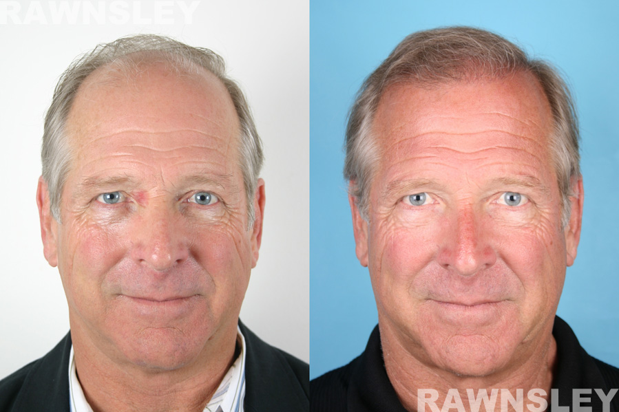 Men Hair Restoration Before & After Photos | Case 13 | Rawnsley Hair Restoration in Los Angeles, CA