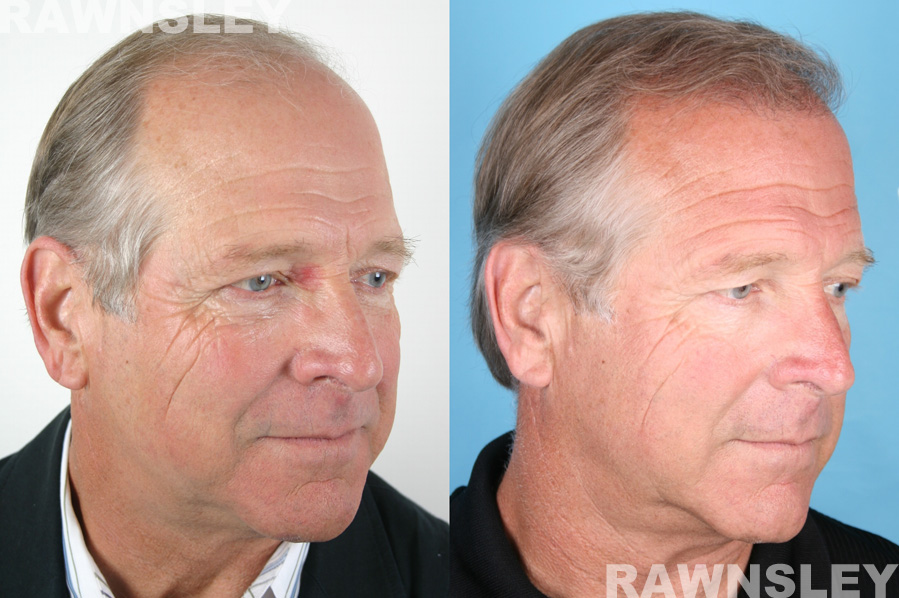 Men Hair Restoration Before and After Photos | Case 13 | Rawnsley Hair Restoration in Los Angeles, CA