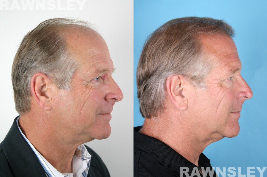 Men Hair Restoration Before and After Results | Case 13 | Rawnsley Hair Restoration in Los Angeles, CA
