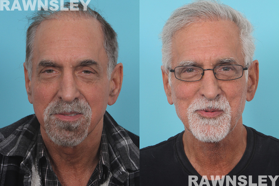 Hair Transplant Before & After Photos | Case 30 | Rawnsley Hair Restoration in Los Angeles, CA