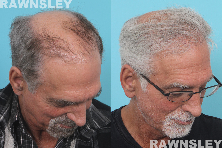 Hair Transplant Before & After | Case 30 | Rawnsley Hair Restoration in Los Angeles, CA