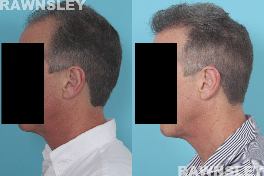 Hair Restoration Before and After Treatment | Case 31 | Rawnsley Hair Restoration in Los Angeles, CA