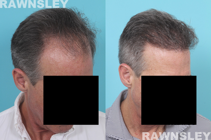 Hair Restoration Before and After Treatment | Case 31 | Rawnsley Hair Restoration in Los Angeles, CA