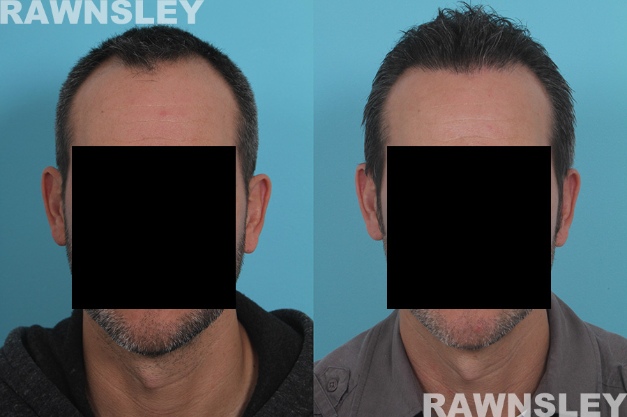 Hair Restoration Before and After Photos | Case 32 | Rawnsley Hair Restoration in Los Angeles, CA