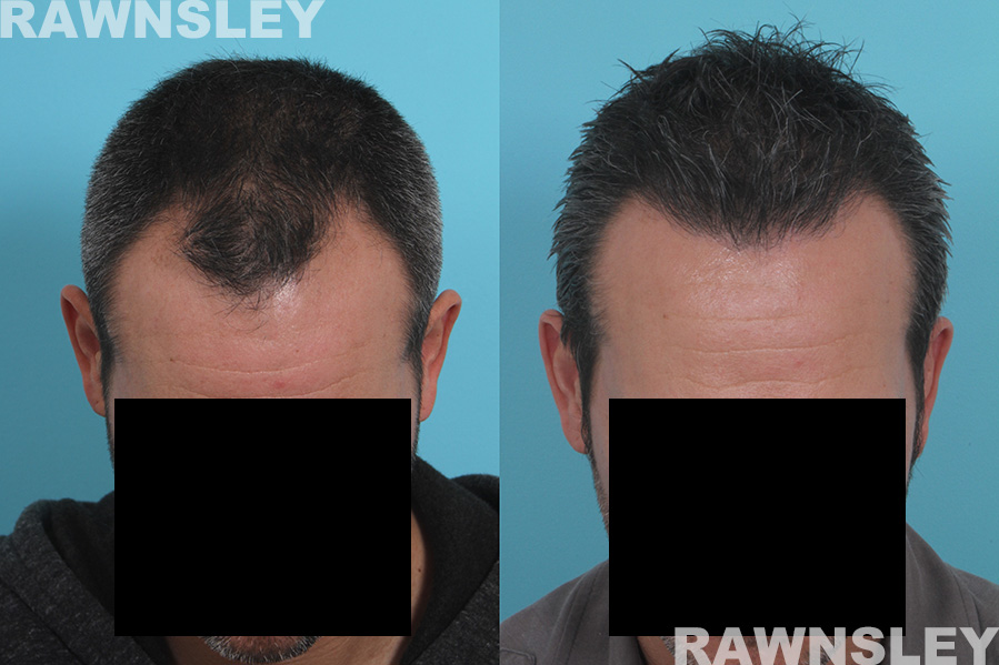 Hair Restoration Before and After Pictures | Case 32 | Rawnsley Hair Restoration in Los Angeles, CA
