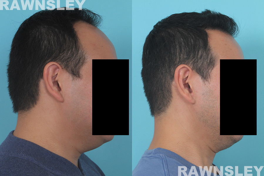 Hair Restoration Before and After | Case 33 | Rawnsley Hair Restoration in Los Angeles, CA