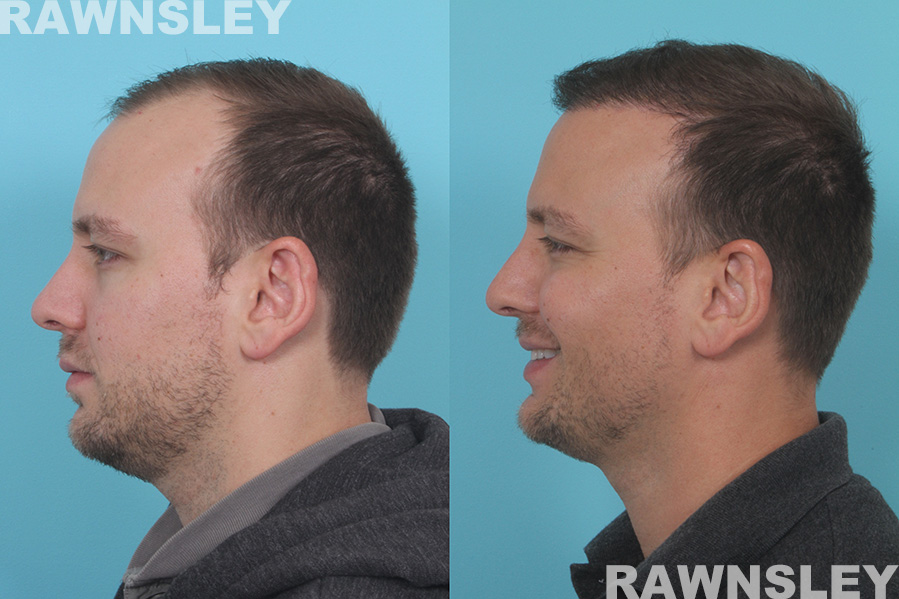 Hair Restoration Treatment Before and After | Case 34 | Rawnsley Hair Restoration in Los Angeles, CA