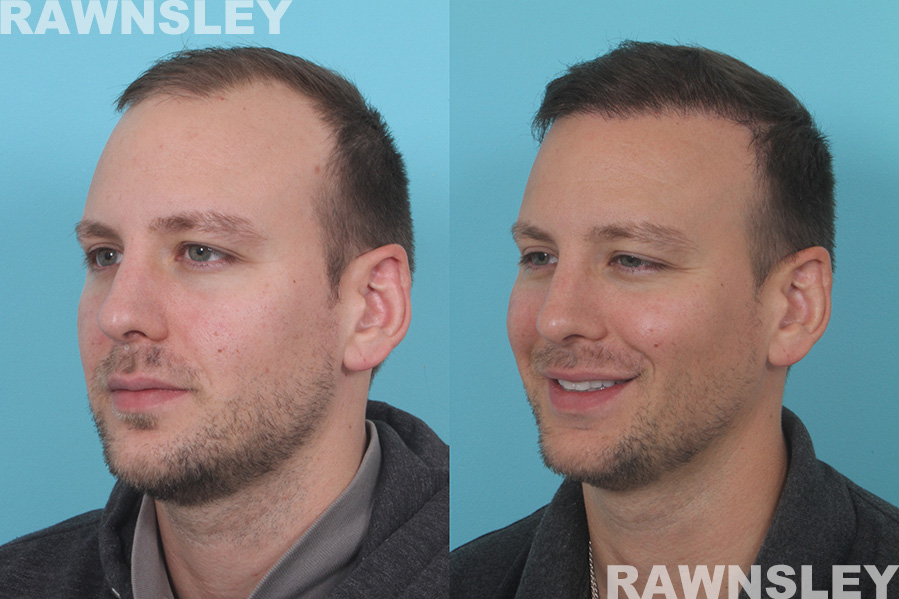 Hair Restoration Treatment Before and After | Case 34 | Rawnsley Hair Restoration in Los Angeles, CA