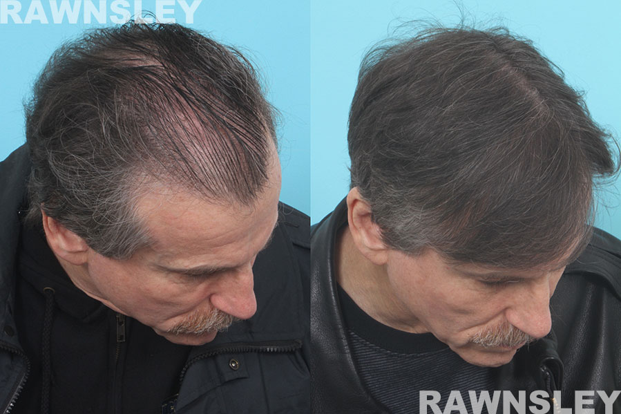 Hair Restoration Before and After Treatment | Case 35 | Rawnsley Hair Restoration in Los Angeles, CA
