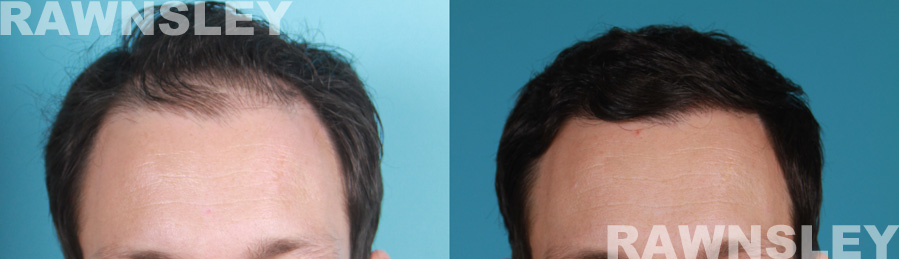 Hair Restoration Before and After Treatment Photos | Case 8 | Rawnsley Hair Restoration in Los Angeles, CA