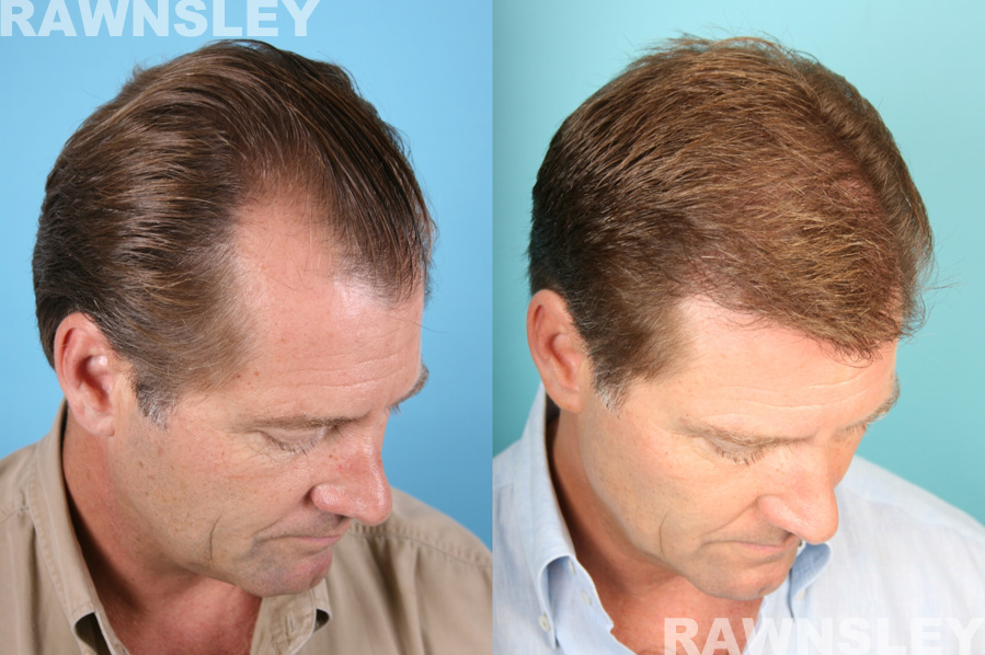 Hair Restoration Before and After Treatment Photos | Case 9 | Rawnsley Hair Restoration in Los Angeles, CA