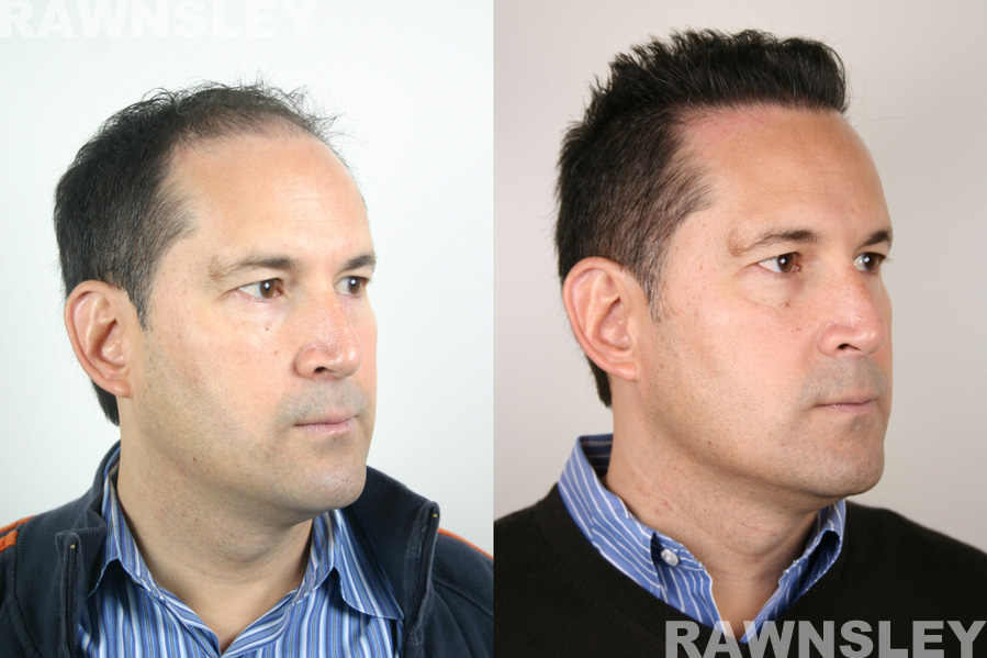 Hair Restoration Before and After Treatment Photos | Case 10 | Rawnsley Hair Restoration in Los Angeles, CA