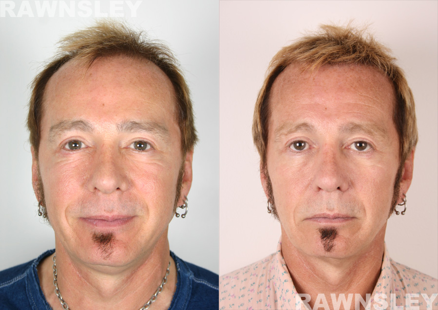 Hair Restoration Before and After Treatment Photos | Case 11 | Rawnsley Hair Restoration in Los Angeles, CA