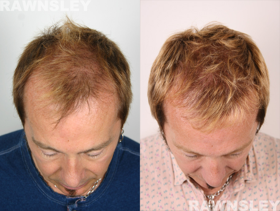 Hair Restoration Before and After Treatment Photos | Case 11 | Rawnsley Hair Restoration in Los Angeles, CA