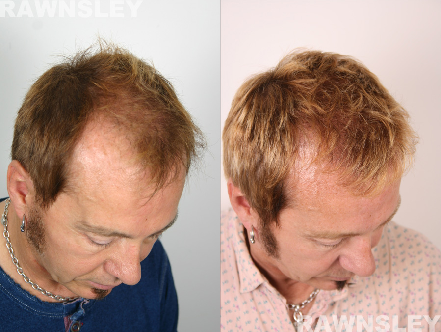 Men Hair Restoration Before & After Treatment | Case 11 | Rawnsley Hair Restoration in Los Angeles, CA