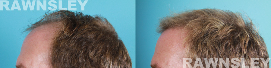 Hair Restoration Before and After Treatment Photos | Case 3 | Rawnsley Hair Restoration in Los Angeles, CA