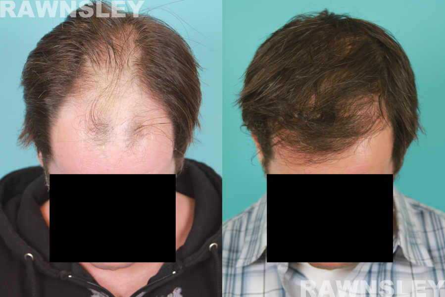 Hair Restoration Before & After Photos | Case 18 | Rawnsley Hair Restoration in Los Angeles, CA