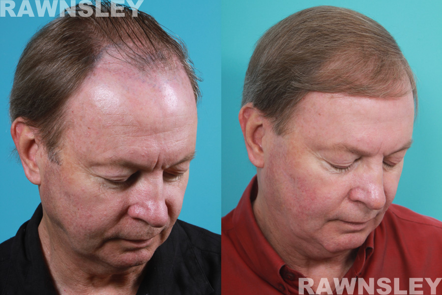 Hair Restoration Before and After | Case 19 | Rawnsley Hair Restoration in Los Angeles, CA