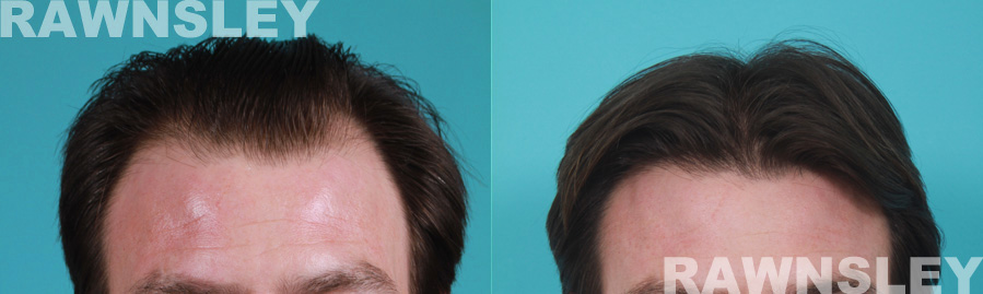 Hair Restoration Before and After Results | Case 20 | Rawnsley Hair Restoration in Los Angeles, CA