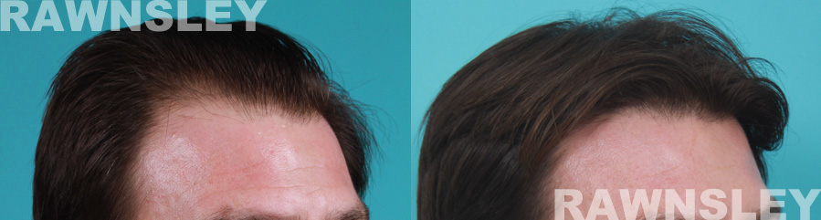 Hair Transplant Before and After Results | Case 20 | Rawnsley Hair Restoration in Los Angeles, CA