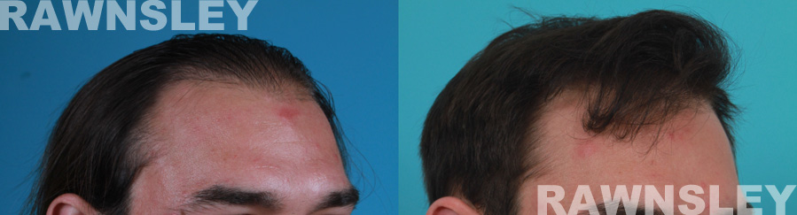 Hair Transplant Before and After Treatment | Case 21 | Rawnsley Hair Restoration in Los Angeles, CA
