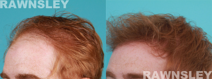 Hair Transplant Before & After Photos | Case 22 | Rawnsley Hair Restoration in Los Angeles, CA
