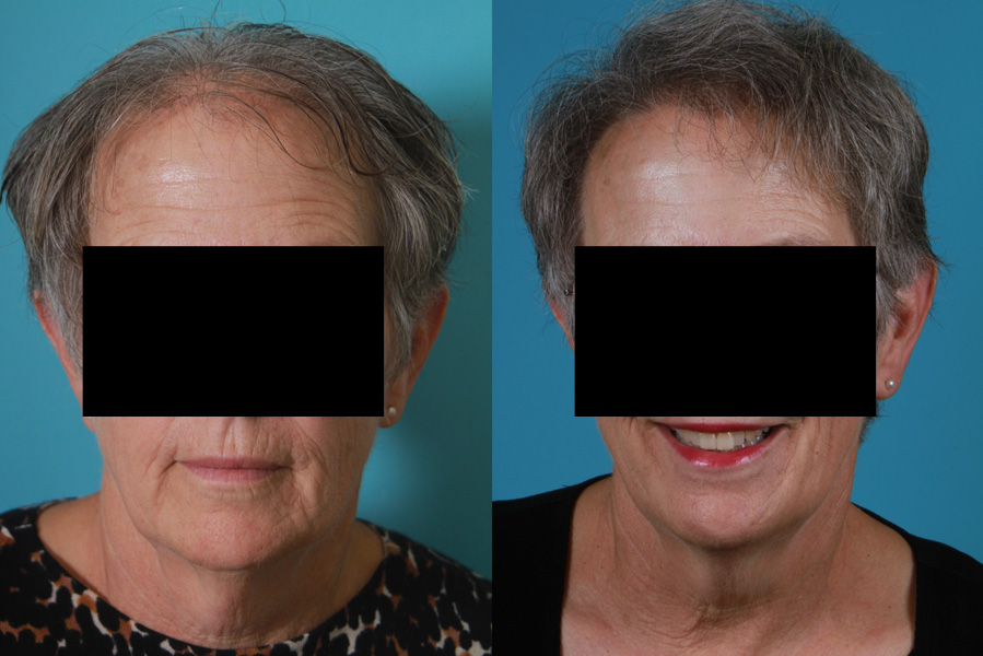 Hair Restoration Before and After Woman | Case 15 | Rawnsley Hair Restoration in Los Angeles, CA