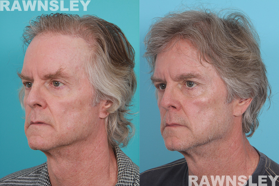 Hair Restoration Before & After Results | Case 23 | Rawnsley Hair Restoration in Los Angeles, CA