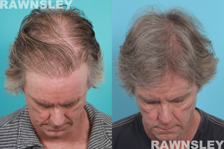 Hair Restoration Before & After Results | Case 23 | Rawnsley Hair Restoration in Los Angeles, CA