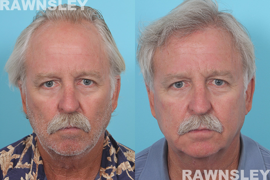 Hair Restoration Before & After Photos | Case 24 | Rawnsley Hair Restoration in Los Angeles, CA