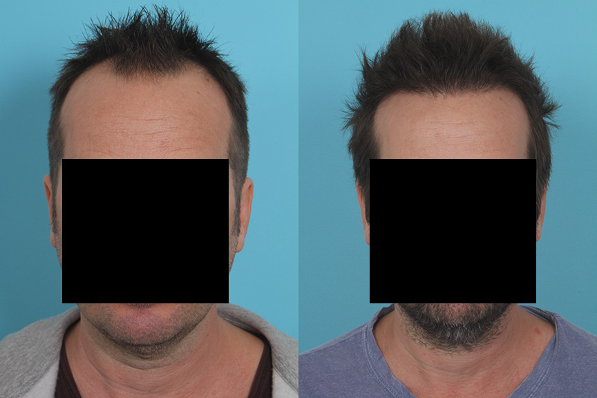 Hair Transplant Before & After Photos | Case 26 | Rawnsley Hair Restoration in Los Angeles, CA