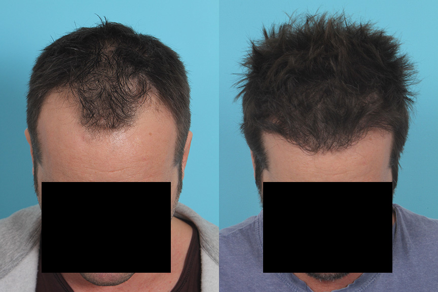 Hair Transplant Before & After | Case 26 | Rawnsley Hair Restoration in Los Angeles, CA