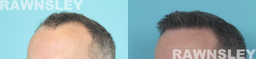 Hair Transplant Before & After Treatment | Case 27 | Rawnsley Hair Restoration in Los Angeles, CA