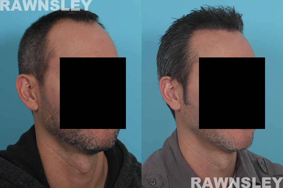 Hair Restoration Before and After Images | Case 32 | Rawnsley Hair Restoration in Los Angeles, CA