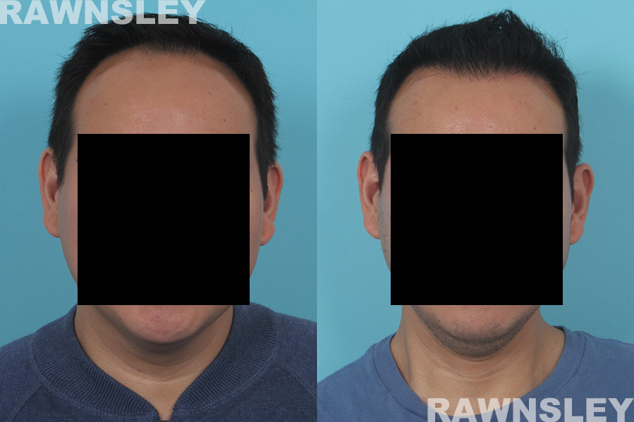 Hair Restoration Treatment Before and After | Case 33 | Rawnsley Hair Restoration in Los Angeles, CA
