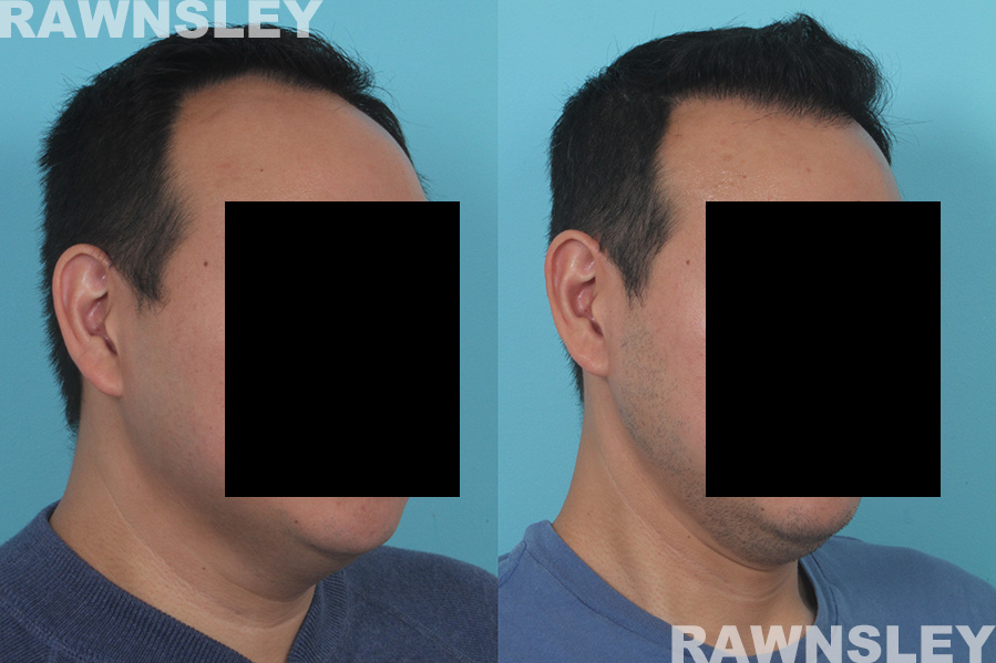 Hair Restoration Before and After Pictures | Case 33 | Rawnsley Hair Restoration in Los Angeles, CA