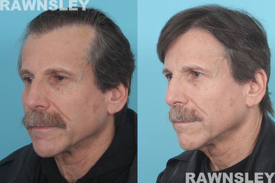 Before and After Hair Restoration Treatment | Case 35 | Rawnsley Hair Restoration in Los Angeles, CA