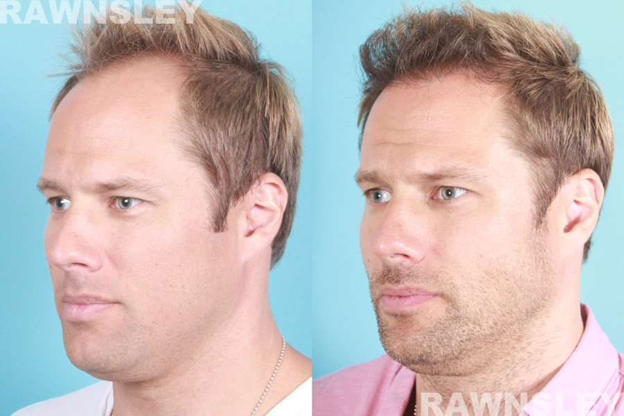 Hair Restoration Before and After Treatment Photos | Rawnsley Hair Restoration in Los Angeles, CA