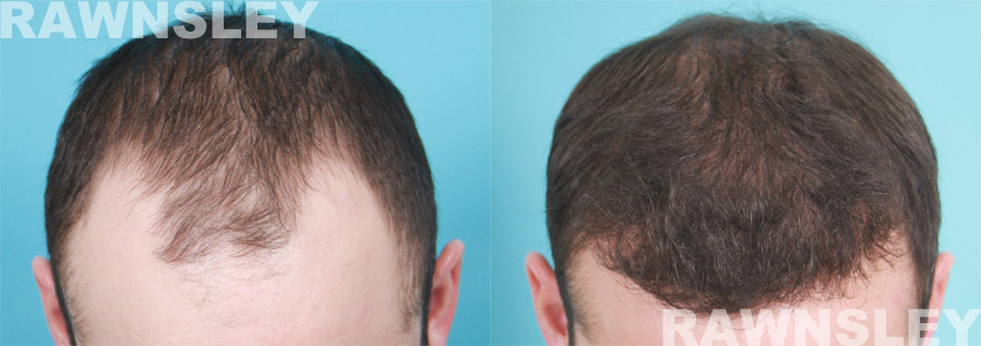 Hair Restoration Before and After Treatment Photos | Case 6 | Rawnsley Hair Restoration in Los Angeles, CA