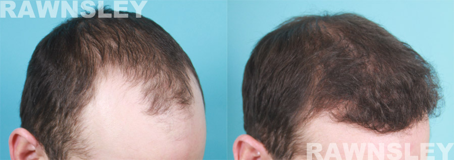 Hair Restoration Before and After Treatment Photos | Case 6 | Rawnsley Hair Restoration in Los Angeles, CA