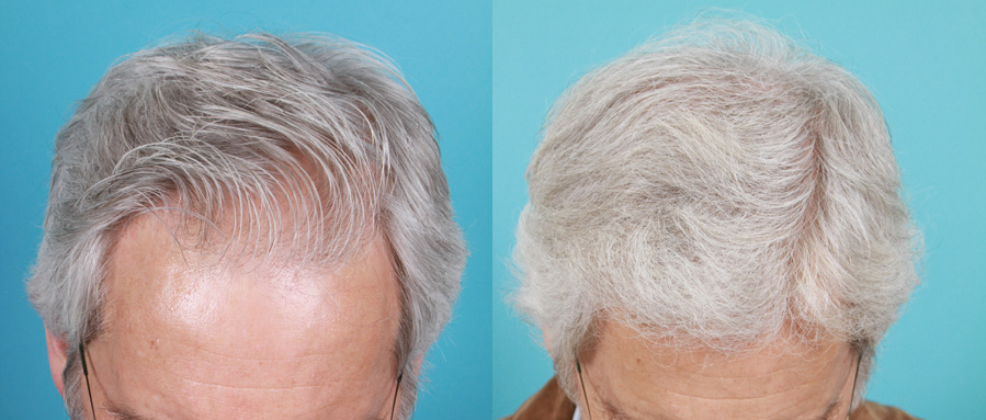 Hair Restoration Before and After Treatment Photos | Case 7 | Rawnsley Hair Restoration in Los Angeles, CA